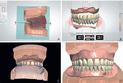 Digital Dentures Plantation | Dr. Hervas Fort Lauderdale Dental Office