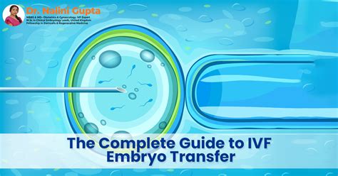 The Complete Guide to IVF Embryo TransferThe Complete Guide to IVF Embryo Transfer | by ...