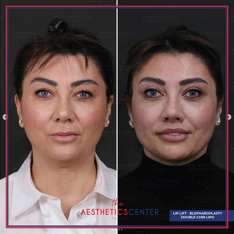 Lip Lift – Aesthetic Center Turkey