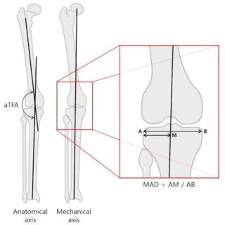 The anatomical tibiofemoral angle (aTFA) was measured on full-length... | Download Scientific ...