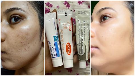 Dermatologist Recommended Best Creams to remove Pimple Marks, Acne ...