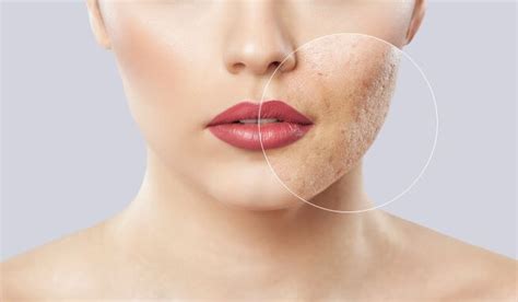 How to Treat Acne Scars with IPL - U.S. Dermatology Partners