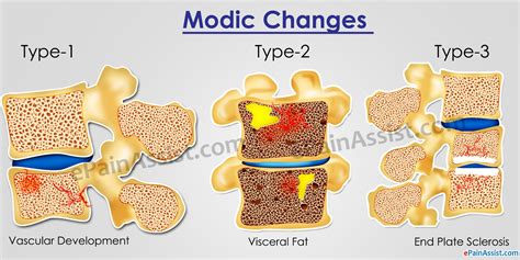 Pin on Back Pain