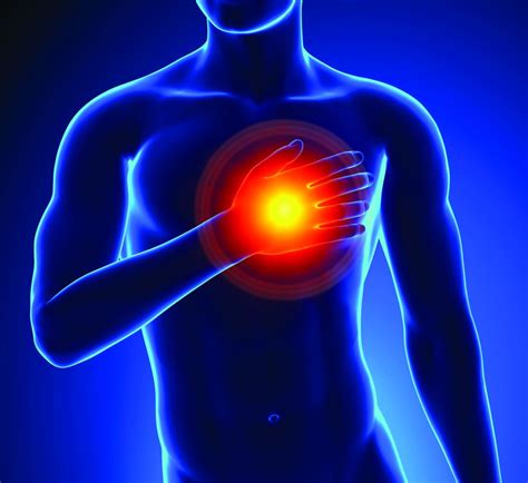 Myocardial Infarction Photo