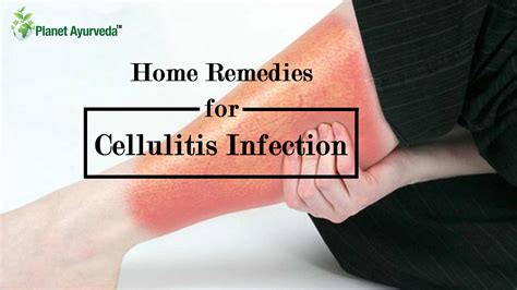 Home Remedies for Cellulitis Infection