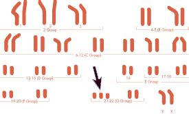 Down Syndrome Chromosome Chart