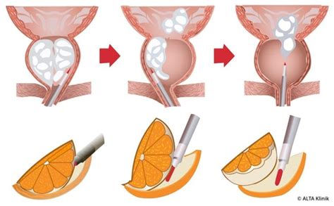 Holmium-Laser-Enukleation der Prostata - HoLEP - ALTA Klinik