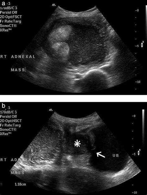 Mature ovarian dermoid cyst invading the urinary bladder - Tandon - 2010 - Ultrasound in ...