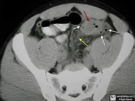 Learning Radiology - diverticulitis, diverticulosis