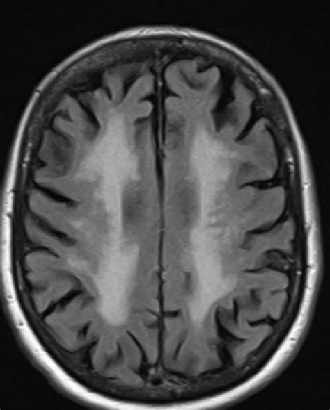 Periventricular White Matter Lesions | Simple