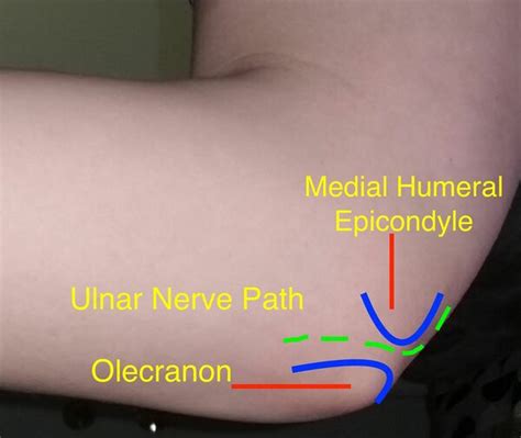 Ulnar Nerve Block - WikiMSK