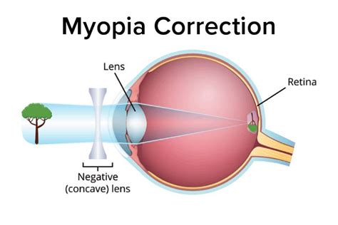 What Type of Lens Is Used To Correct Nearsightedness?