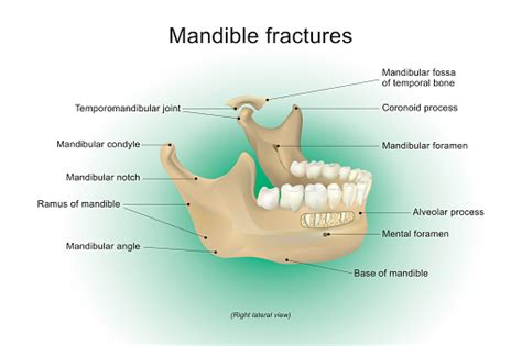 Mandible Fractures Vector Anatomy Human Stock Illustration - Download Image Now - iStock