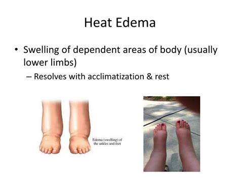 PPT - Heat Related Illness PowerPoint Presentation, free download - ID ...