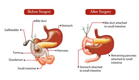 Pancreas Surgery