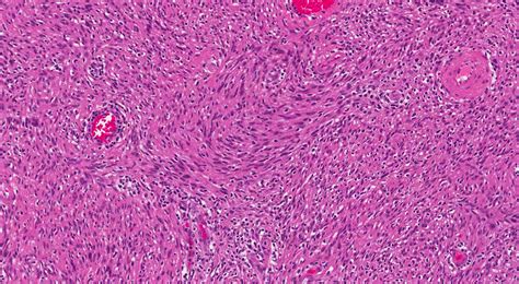 Spindle cell neoplasm | MyPathologyReport.ca