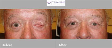 Prosthetic Eye & Socket Surgery Before and After Photos | Taban MD