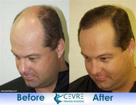 Before and After Hair Transplant in Turkey at Cevre Hospital