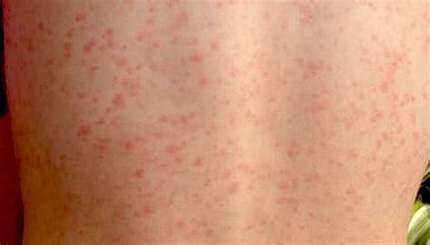 Scarlet fever: Causes, symptoms, treatment, and complications