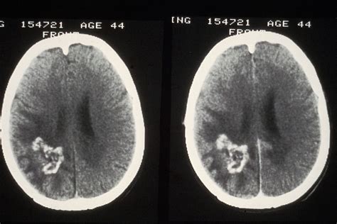 Cat Scan Brain Tumor