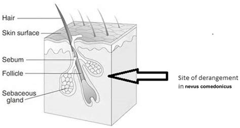 Nevus comedonicus causes, symptoms, complications & treatment