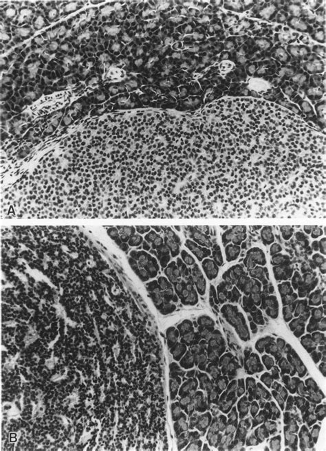 Histopathology of islet cell adenoma (A) and carcinoma (B) obtained ...