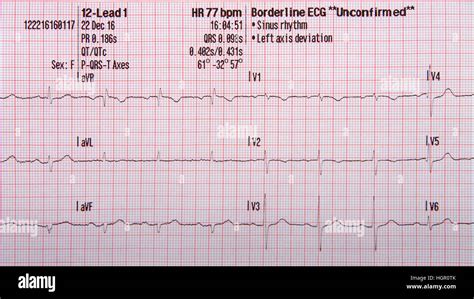 12 lead EKG strip showing normal sinus rhythm with unconfirmed left ...