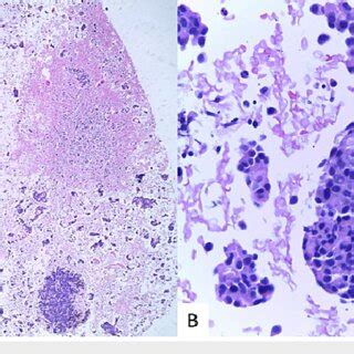 Metastatic carcinoma of the breast (fine needle aspiration) -cell... | Download Scientific Diagram