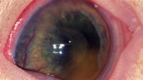 Top 5 Classifications of Blindness | Clinician's Brief