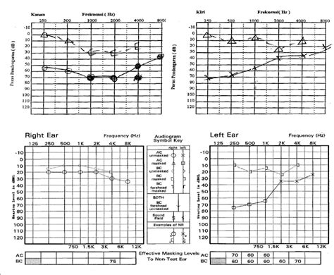 Otosclerosis Audiogram