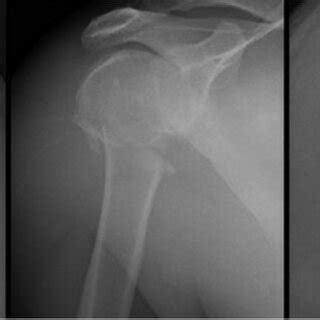 Axillary shoulder X-ray demonstrating a displaced fracture of the... | Download Scientific Diagram