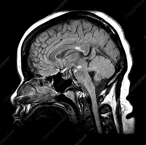 Multiple Sclerosis on MRI - Stock Image - C043/2976 - Science Photo Library