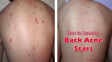 How to Remove Back Acne Scars | DIY Beauty & SPA | Pinterest | Acne scars, To remove and How to ...