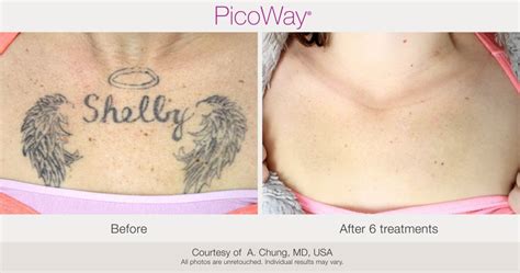 PicoWay Laser Tattoo Removal – Synergy Medical Aesthetics – Nanaimo, Victoria, Vancouver Island