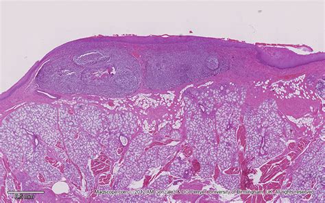 Lingual Tonsil Swelling