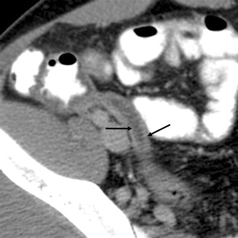 CT Evaluation of Appendicitis and Its Complications: Imaging Techniques and Key Diagnostic ...