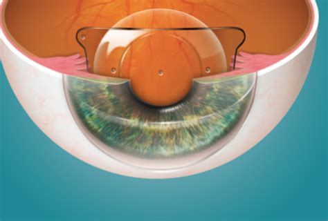 ICL (Implantable Collamer Lens) - Manocha Eye Hospital