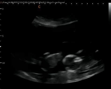 Quadruplets Ultrasound