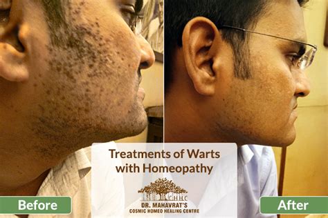 Tottenham: [42+] Brown Flat Warts On Face Treatment