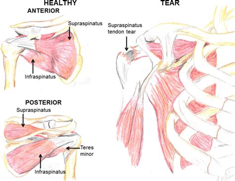 Rotator Cuff Muscle With Anatomical Posterior And Anterior View | The Best Porn Website