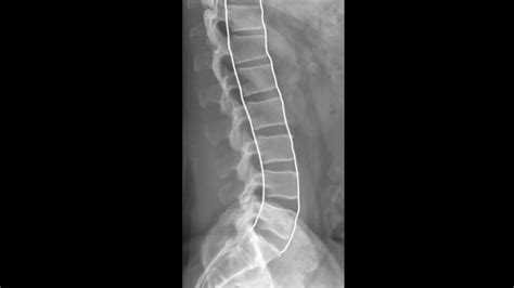 Lumbar Spine Anatomy Xray