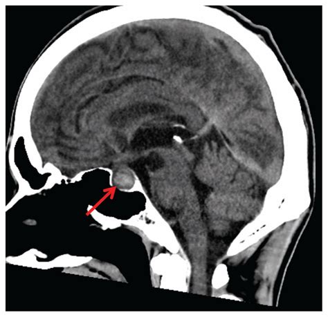 Pituitary apoplexy | CMAJ