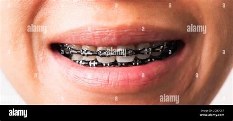 Close up detail macro of young Asian woman smile show mouth with white teeth with black brackets ...