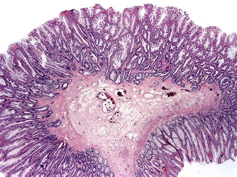 Pathology Outlines - Sessile serrated adenoma