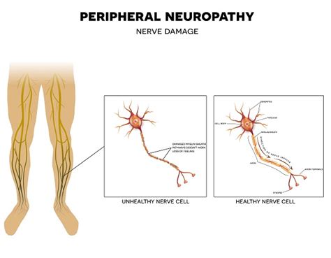 Neuropathy simply means the nerves are dysfunctional.