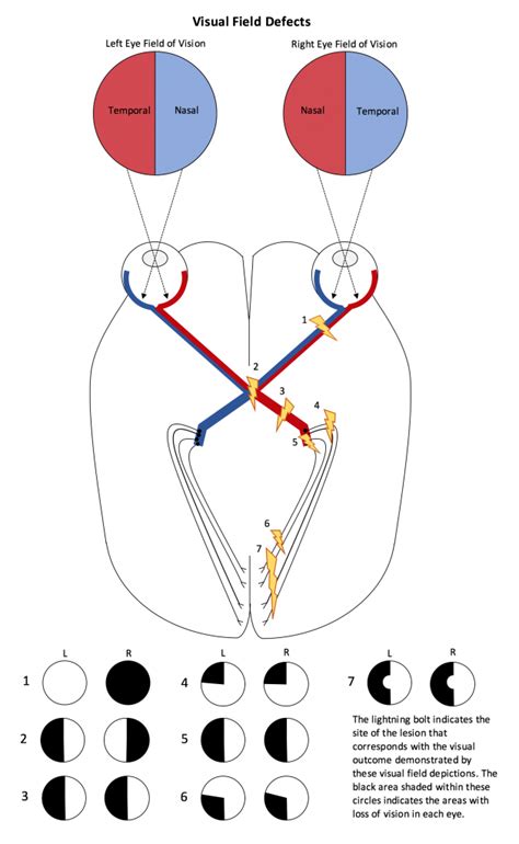 Moran CORE | Hemianopsia