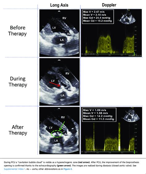 Images of Echocardiography During Procedure | Download Scientific Diagram