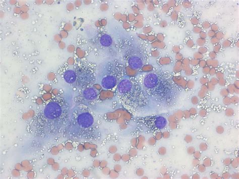 Leydig cell tumour | Case Study | Cytopath