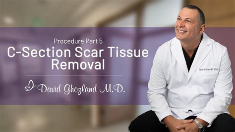 C-Section Scar Tissue Removal | Procedure Part 5 | David Ghozland, M.D. - YouTube