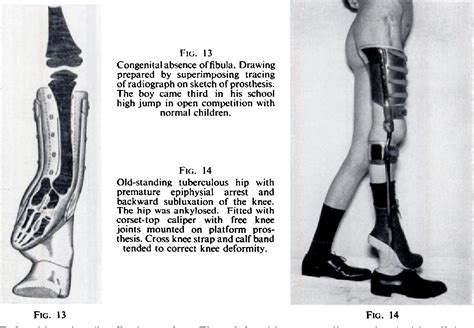 Figure 13 from THE PROSTHETIC MANAGEMENT OF CONGENITAL DEFORMITIES OF THE EXTREMITIES | Semantic ...